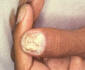 Nail fungus